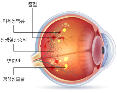 당뇨망막병증 안구