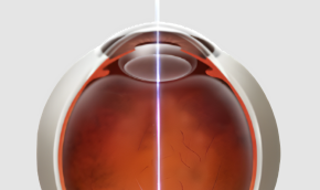 레이저치료 Non-Mydriatic AFC-330