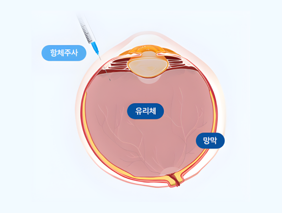 유리체강내주사치료