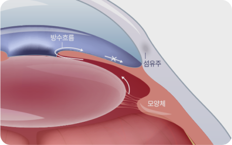 개방각 녹내장