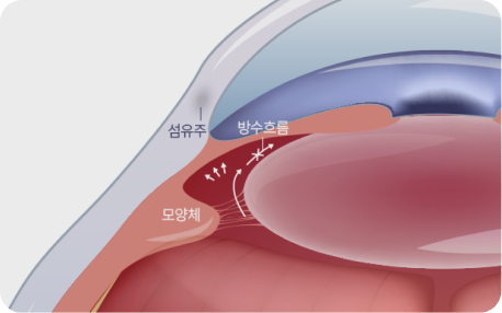폐쇄각 녹내장