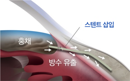 젠 스텐트 삽입술