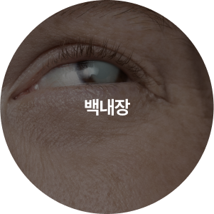 드림렌즈 권장 대상 2